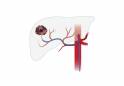 [의료기획] 간암 ‘경동맥 방사선 색전술’